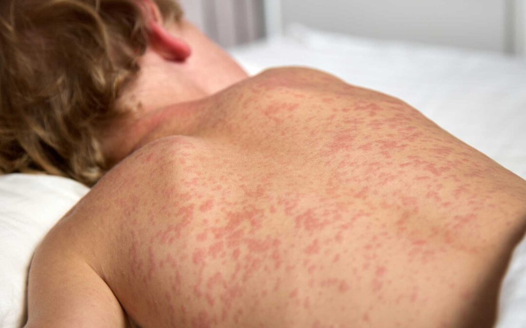 Beyond the Headlines: Understanding Measles and How to Keep Your Child Safe